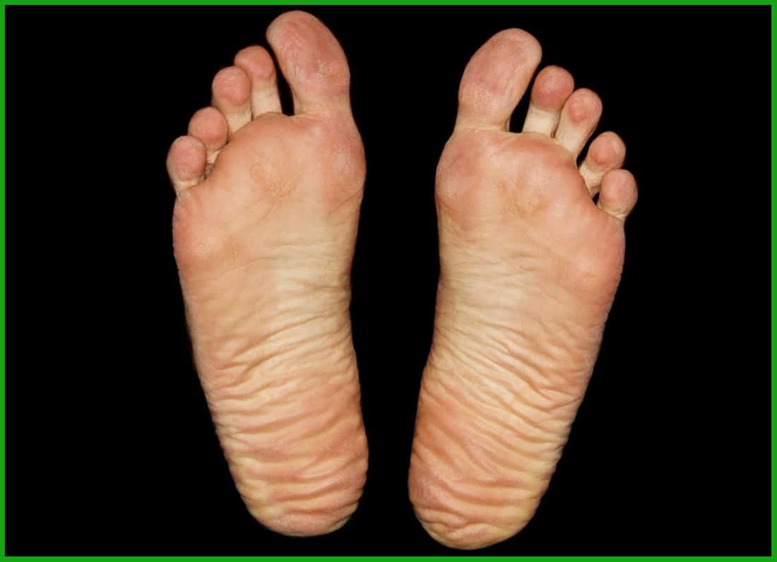how to get rid of bad smelly feet